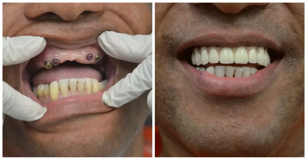 TEETH RECONSTRUCTION