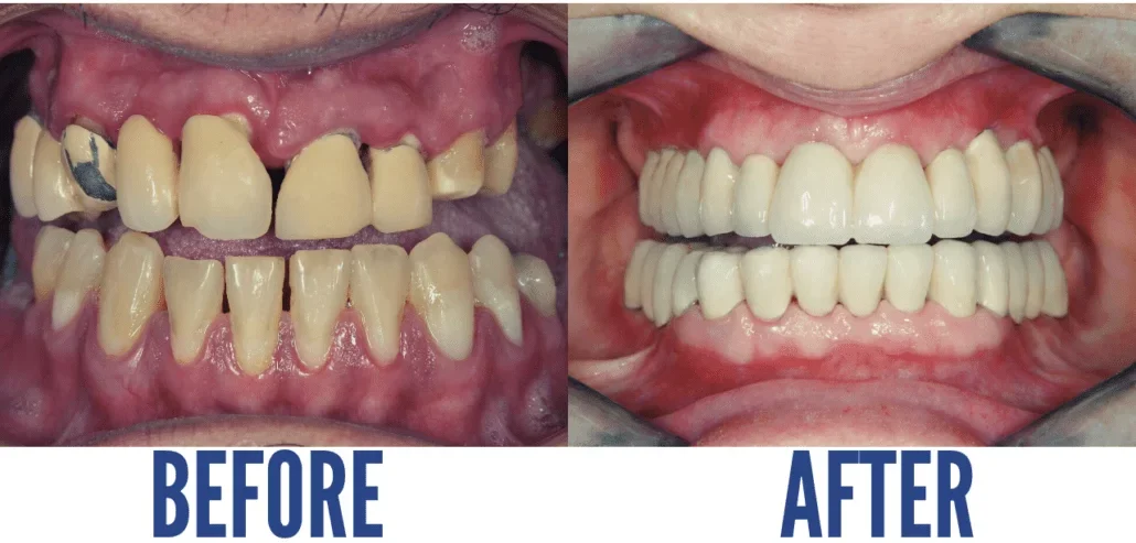 TEETH RECONSTRUCTION1