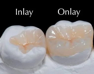 Teeth Inlays And Onlays