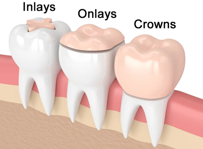 Teeth Inlays And Onlays