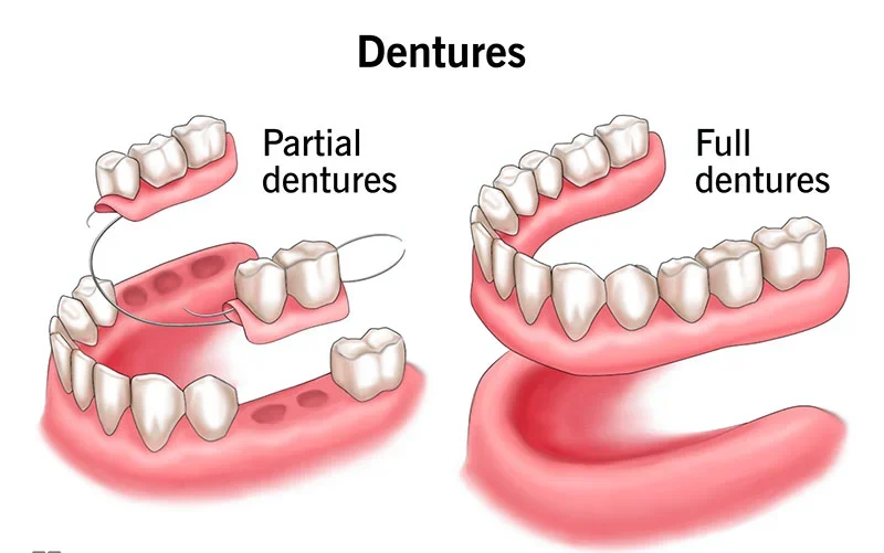 Types Of False Teeth