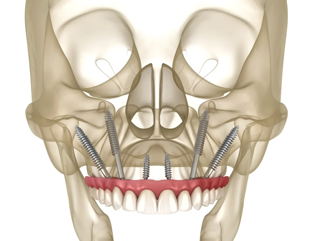 Zygomatic Dental Implants