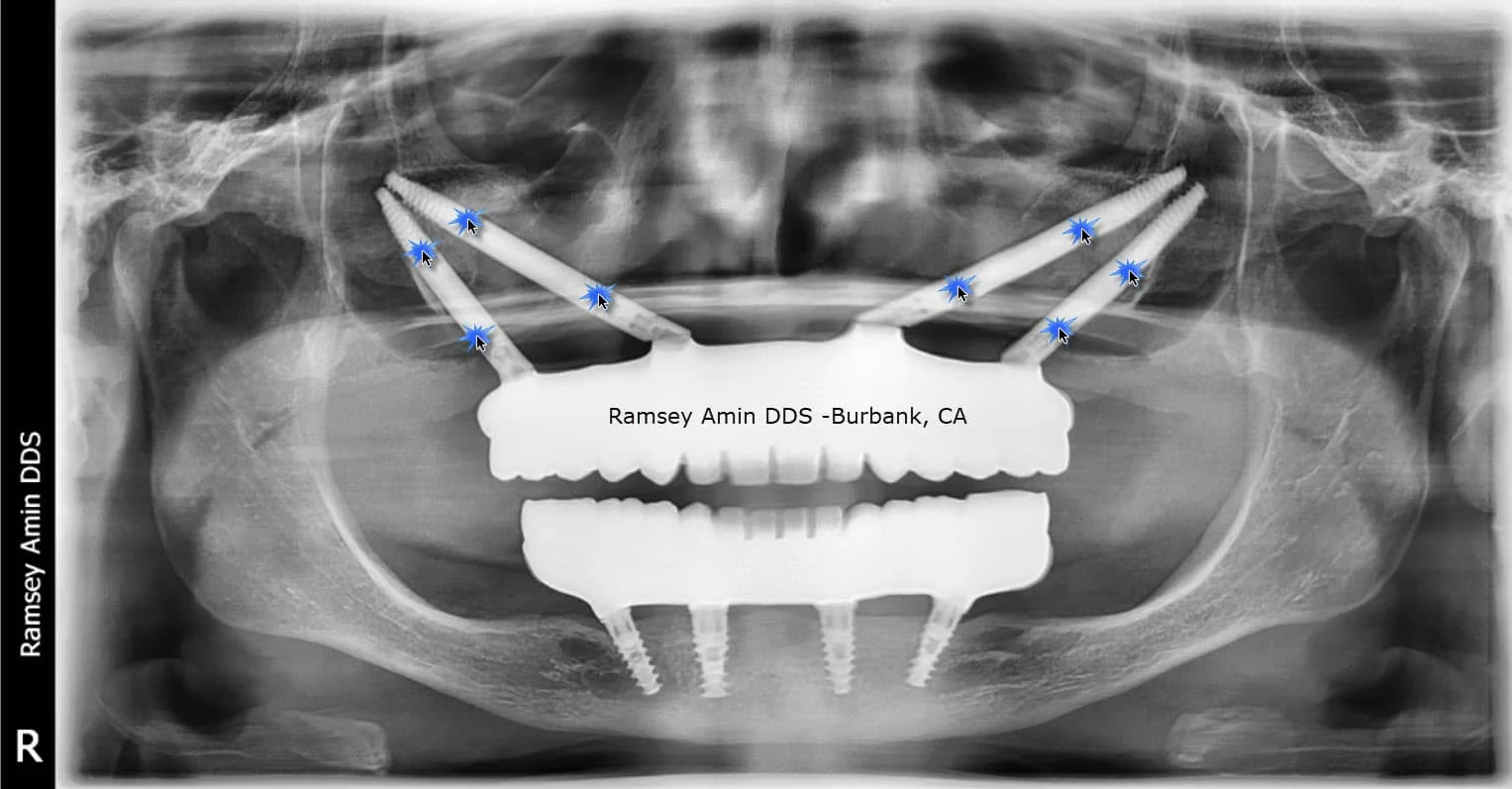 Chirurgia Orale - Clinica Dentale Albania | Tirana e Valona
