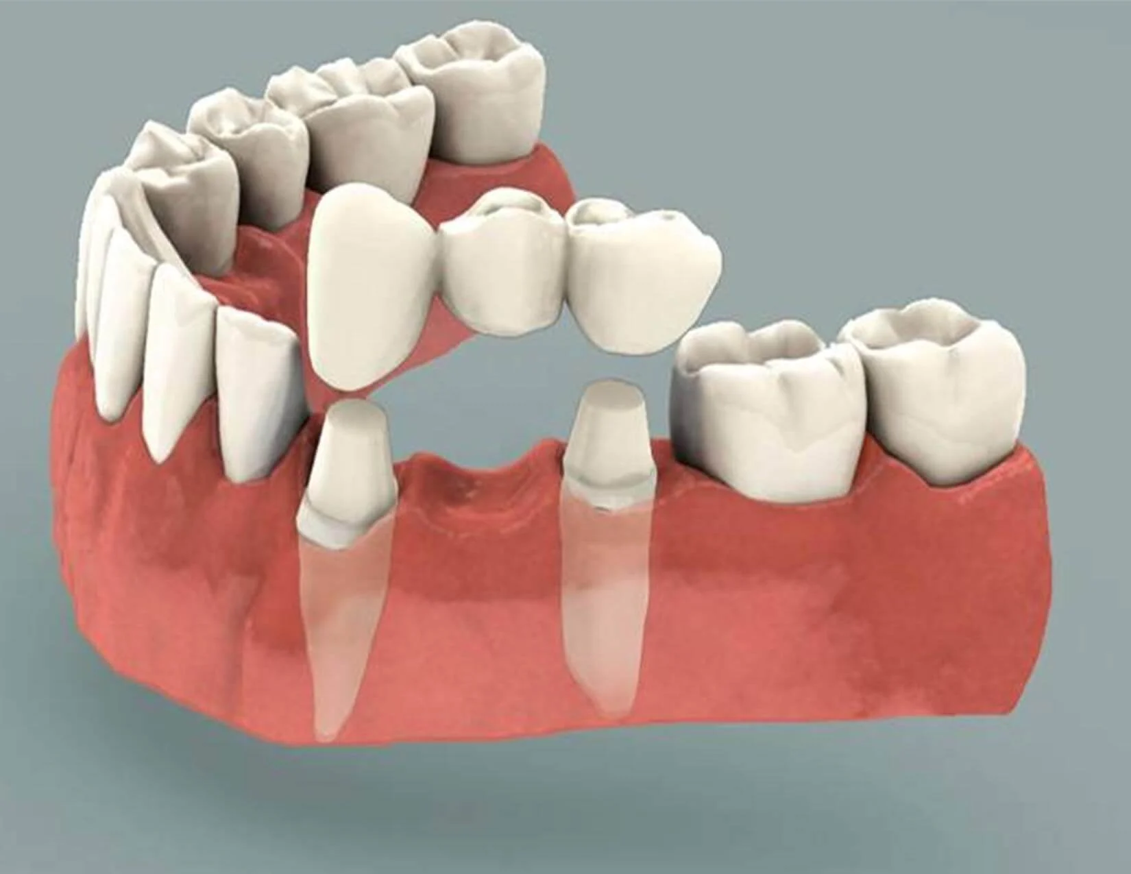 bridge dentistry