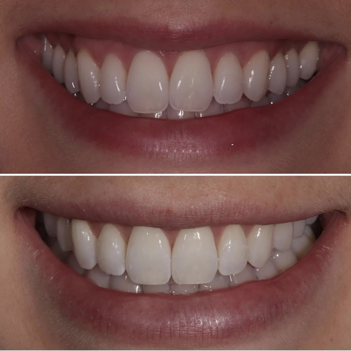teeth filing