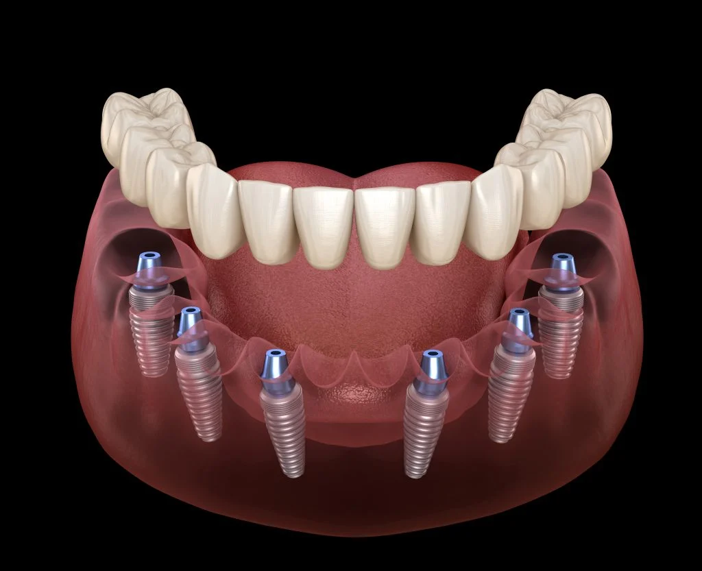 All On Six Dental Implants