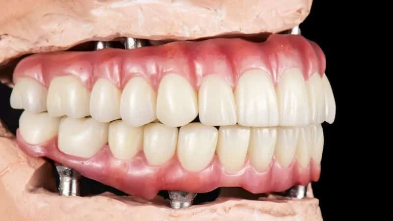 All On Six Dental Implants