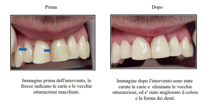 Composito Per Denti