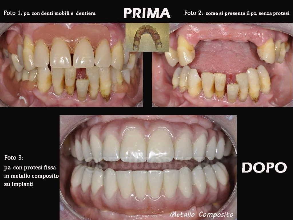 Costi Protesi Dentarie Fisse