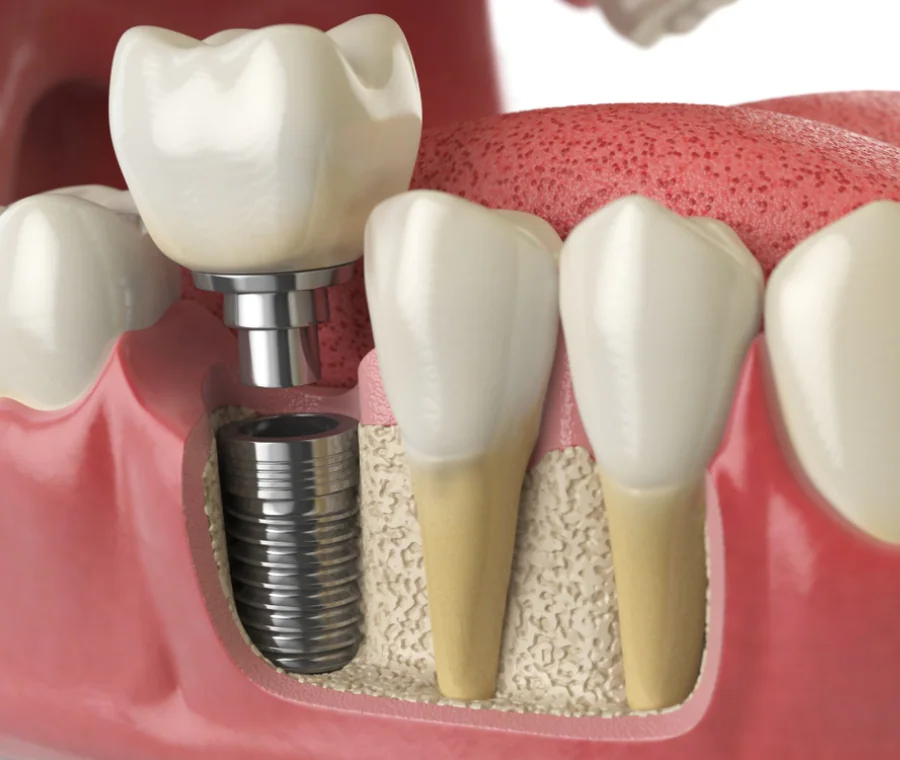 Denti Impianto Fisso