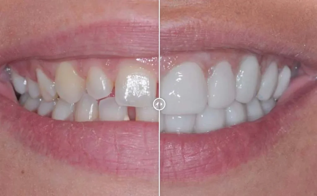 Denti Limati Per Faccette