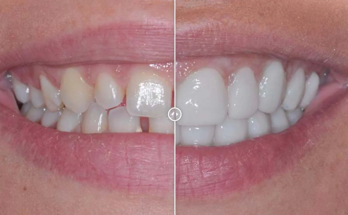 Denti Limati Per Faccette