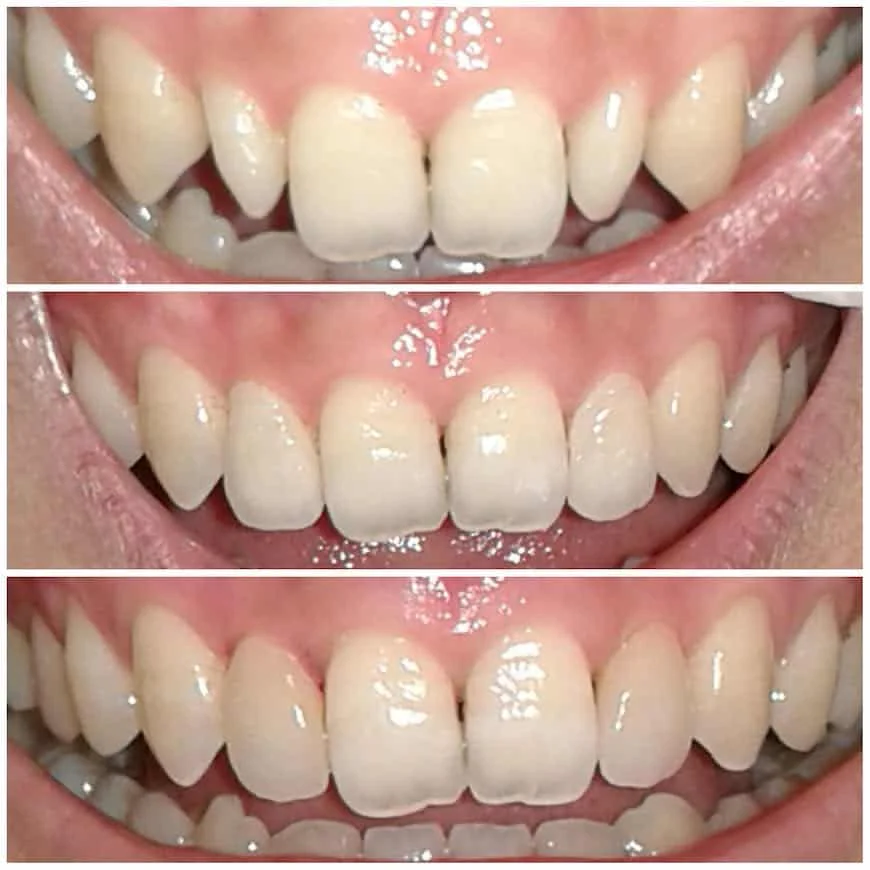 Faccette Estetiche Per Denti