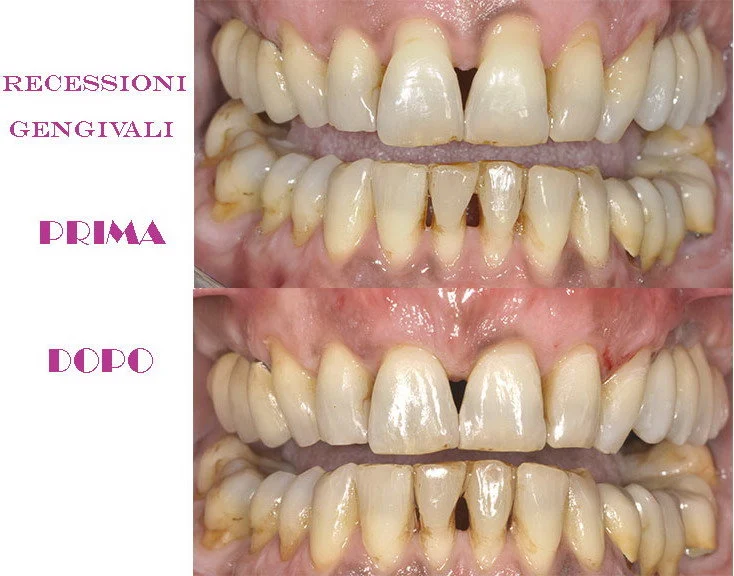 GENGIVE RITIRATE VITAMINE