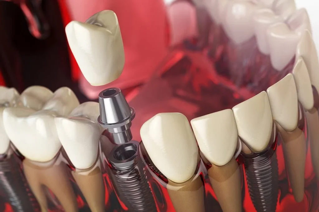 IMPIANTI AL TITANIO DENTI