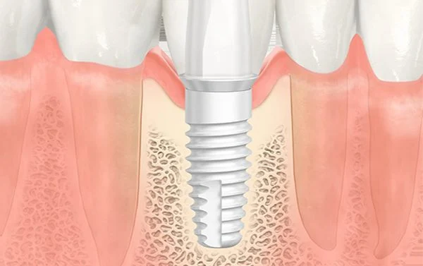 Impianti In Zirconia