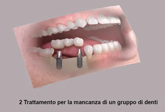 Impianti Per Denti Costi