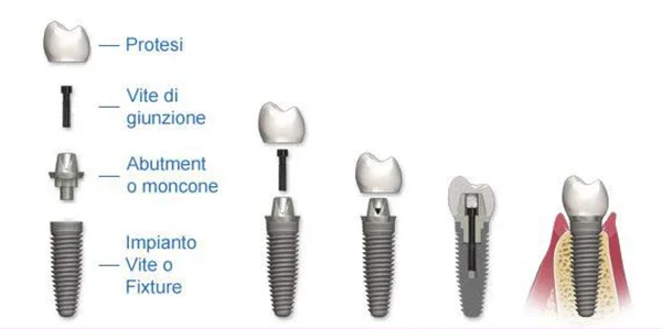 Impianto A Vite Per Denti