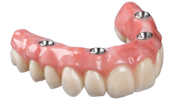 PROTESI DENTARIE FISSE DI ULTIMA GENERAZIONE COSTI