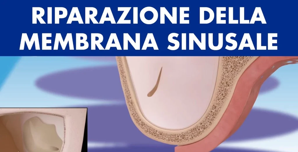 PERFORAZIONE SENO MASCELLARE SINTOMI