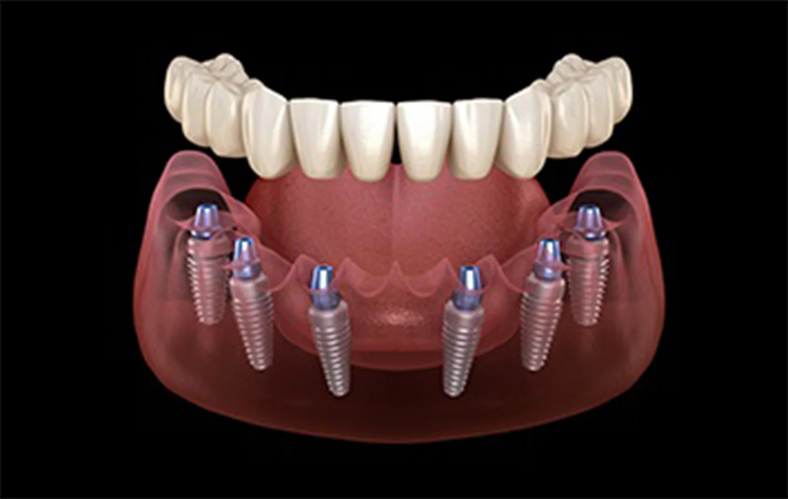 Perni Dentali