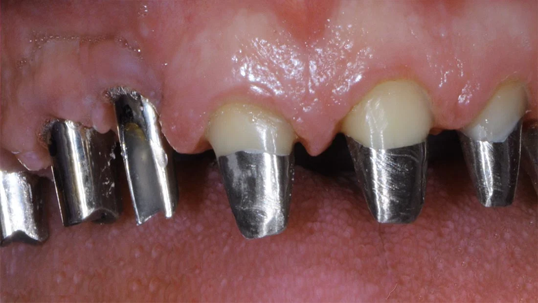 Perni Per Denti1