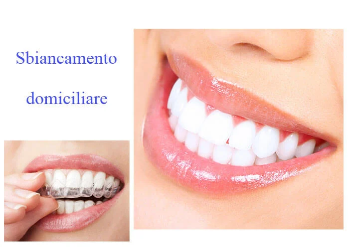 Quanto Costa La Sbiancatura Dei Denti
