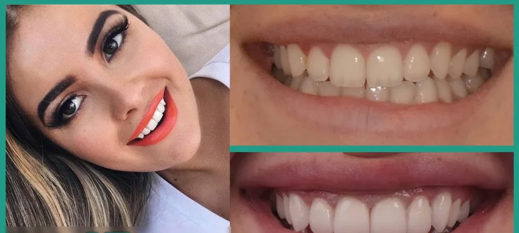 Quanto Costano Le Faccette Dentali