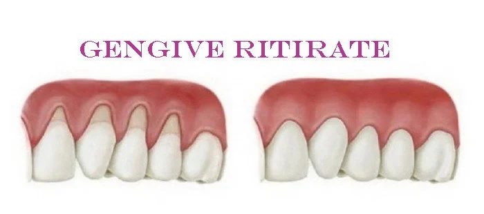 RITIRO DELLE GENGIVE