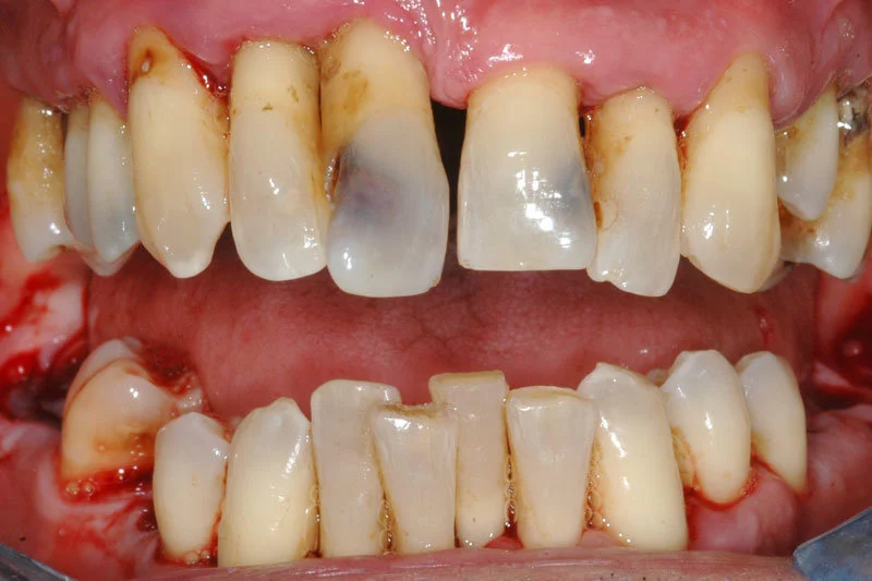 RITIRO DELLE GENGIVE