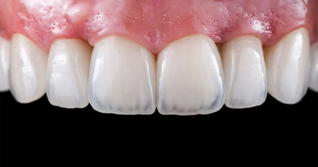 Ricostruire Un Dente