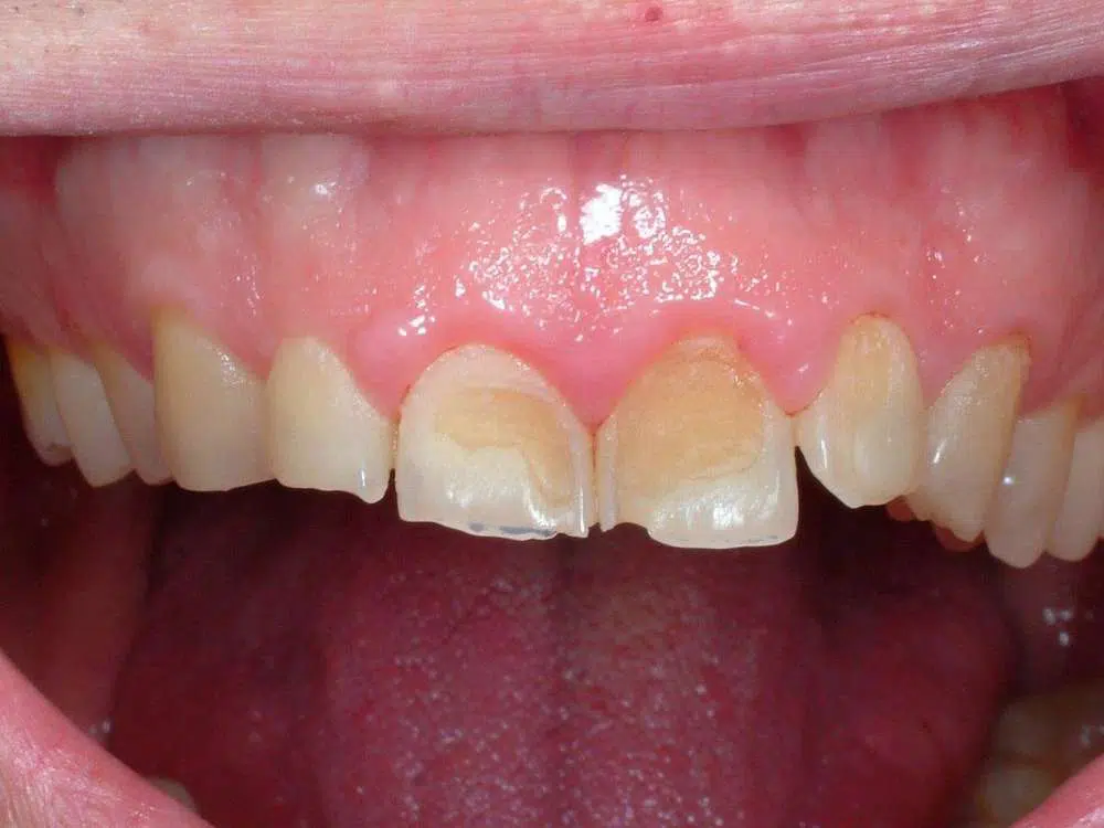 Sbiancamento Naturale Dei Denti