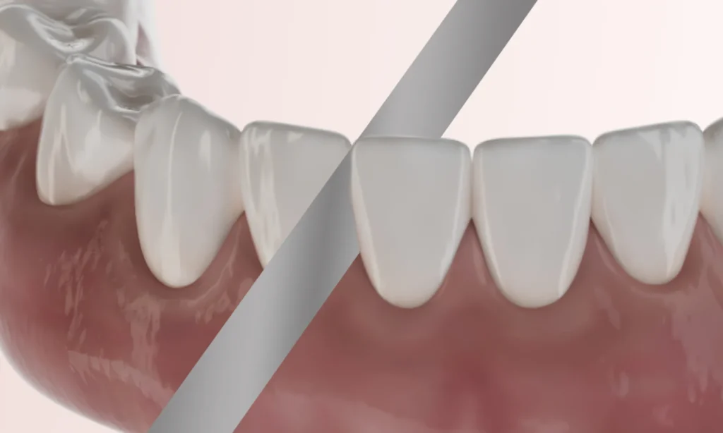 Stripping Denti Cos'è Come Funziona