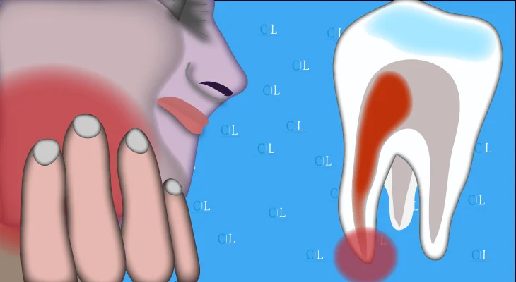 Dente da latte caduto con radice