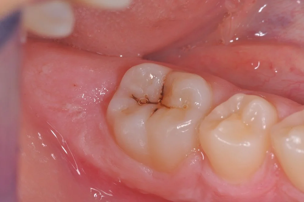 Sigillatura dei molari