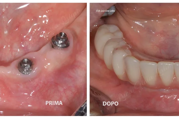 ALL ON 4 IMPLANTOLOGIA1