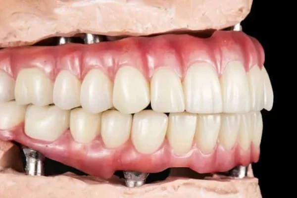 All On Six Dental Implants