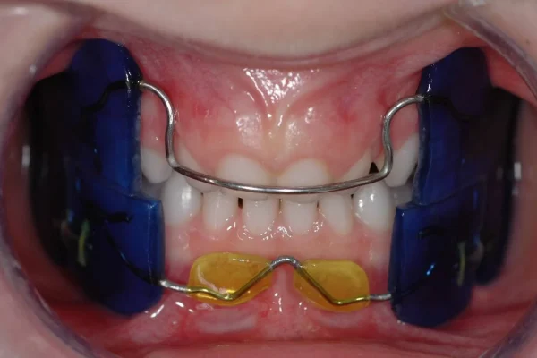 Apparecchio Bambini Per Malocclusione1