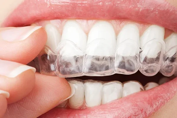 Bleach Teeth At Home