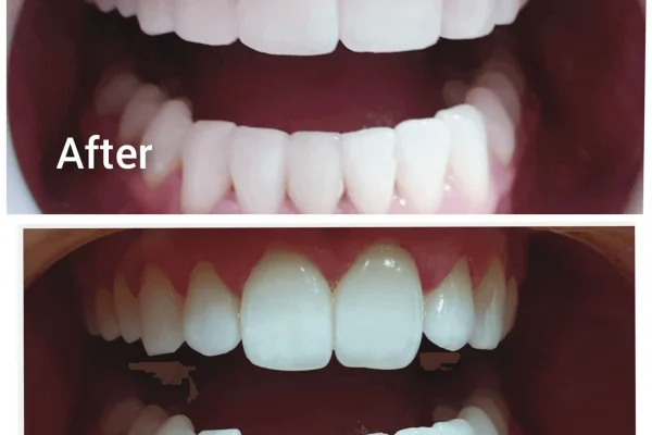 Bonded Teeth
