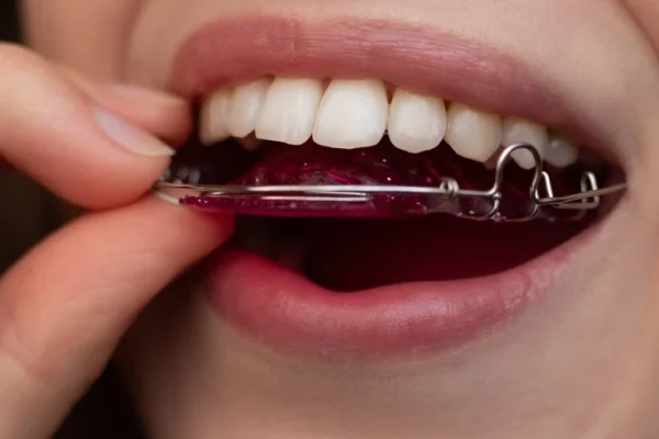 Brace Retainers After Braces1