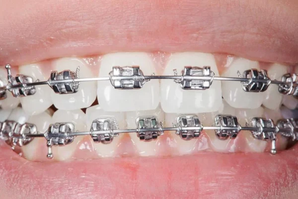 Braces