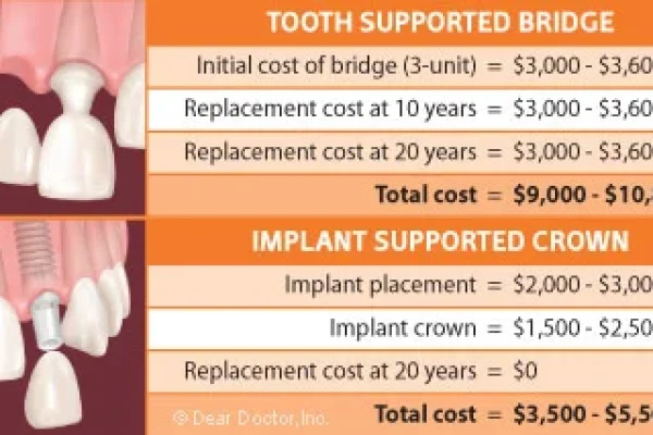Bridge Work Dental Cost
