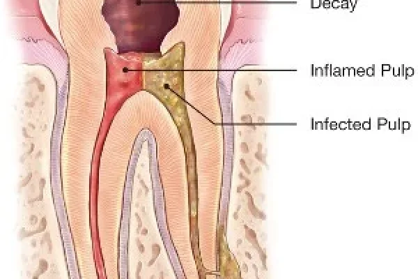 CANAL ROOT TREATMENT1