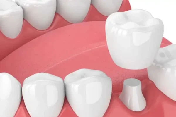 CAPSULE DENTALI COSTI1