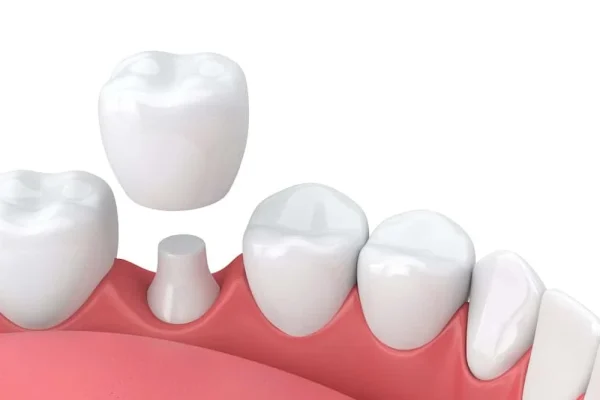Capsula Dente Provvisoria1