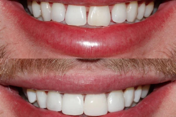 Composite Dental Bonding