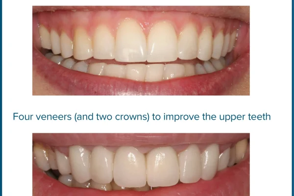 Composite Resin Bonding Teeth