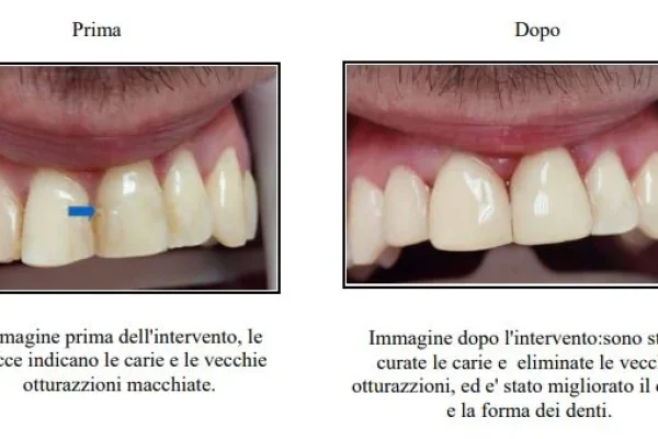 Composito Per Denti