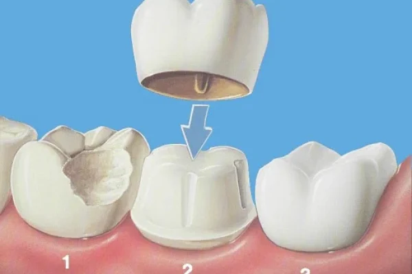 Corona Dentale in Ceramica Prezzo4